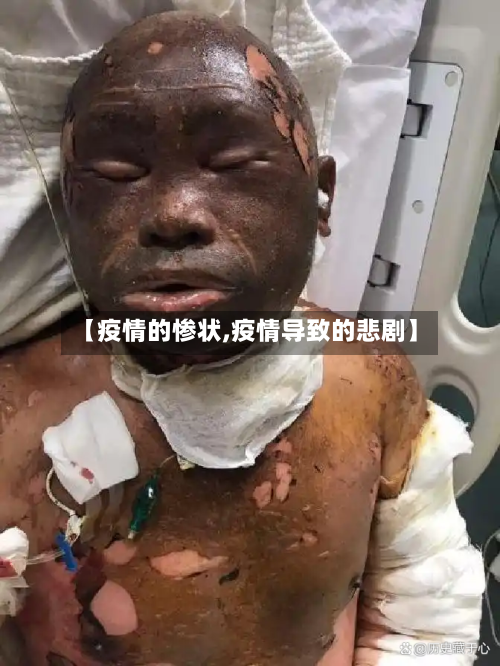 【疫情的惨状,疫情导致的悲剧】